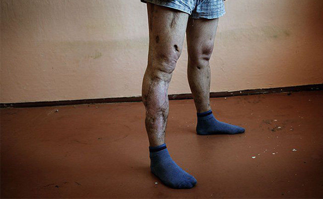 Krokodil Use and Abuse in Australia